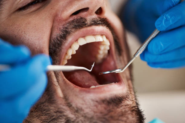 Best Chipped Tooth Repair Near Me  in Cutler Bay, FL